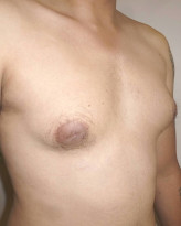 Gynecomastia