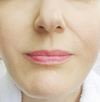 Lip Augmentation