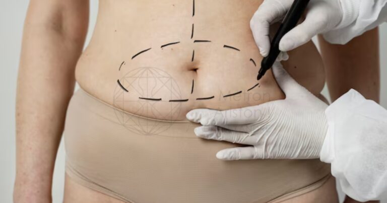 What is Advanced Liposculpture 9