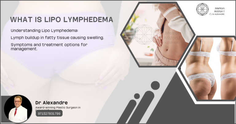 What Is Lipo Lymphedema