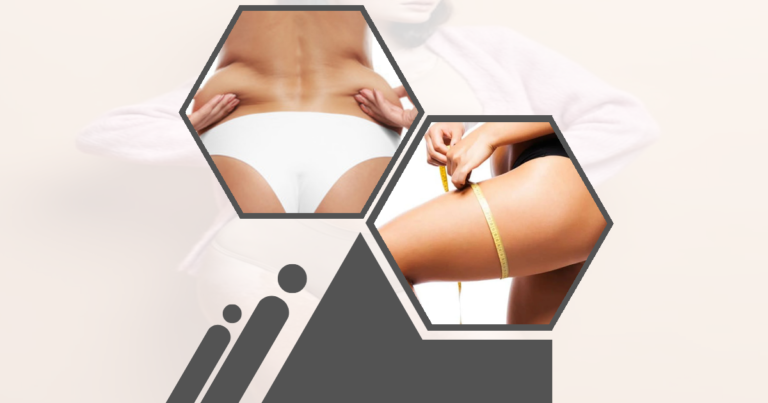 Can Liposuction Fix Hip Dips