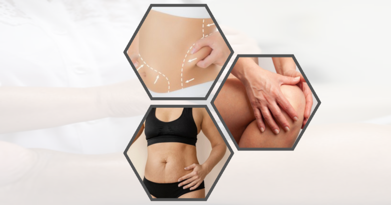 Will Liposuction Get Rid Of Belly Fat